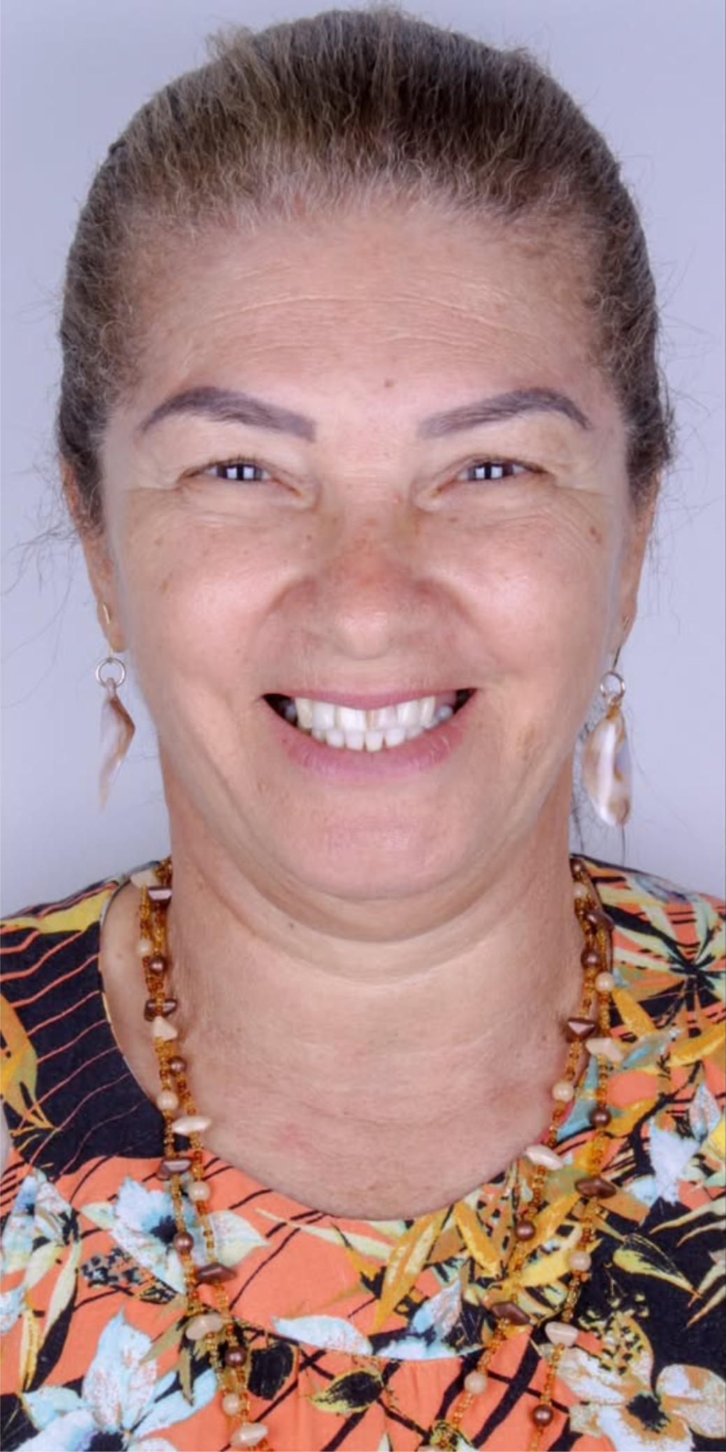 Caso Lentes em Porcelana antes