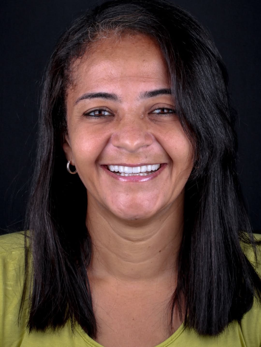 Resultado estético em facetas com acabamento natural na DentClin