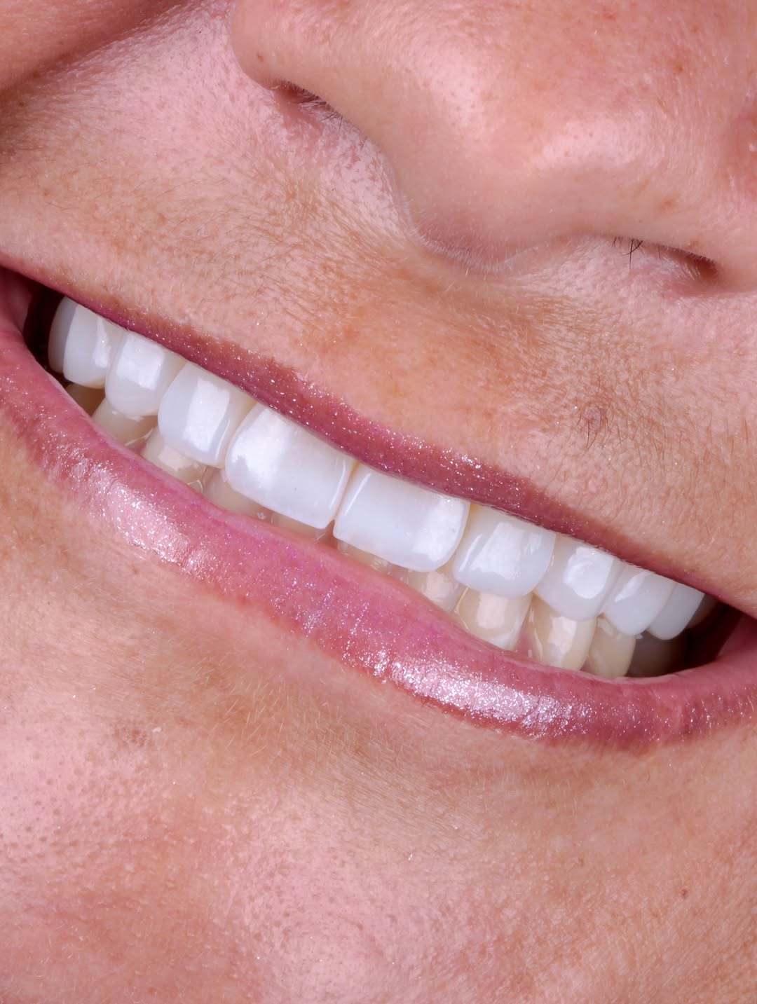Resultado estético em facetas com acabamento natural na DentClin