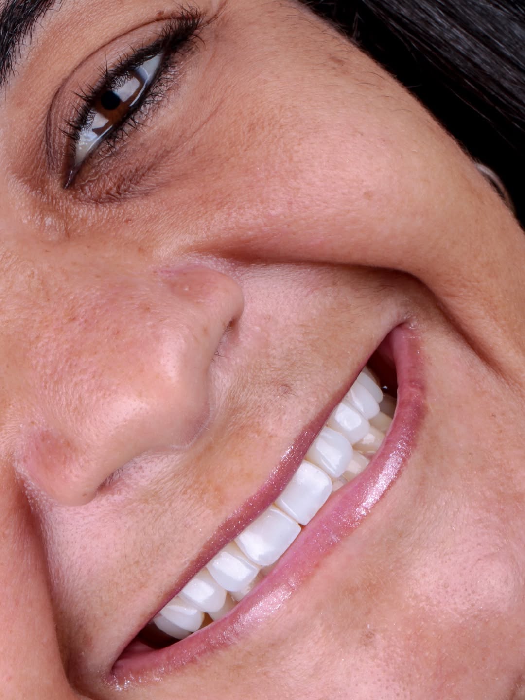 Resultado estético em facetas com acabamento natural na DentClin