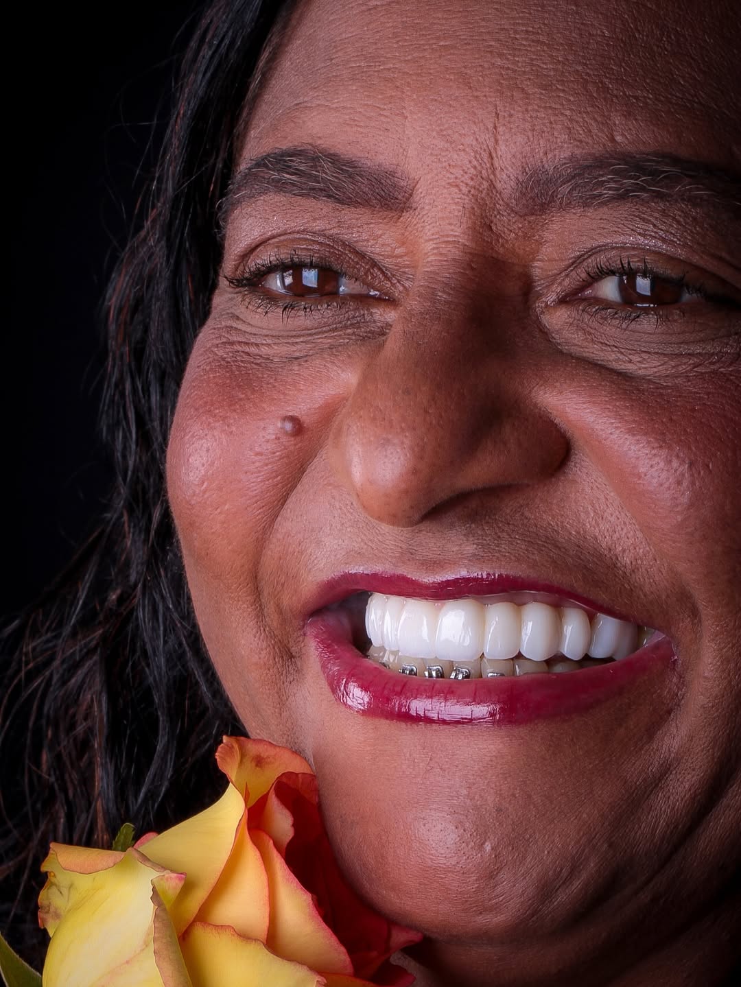 Implantes e prótese fixa na DentClin