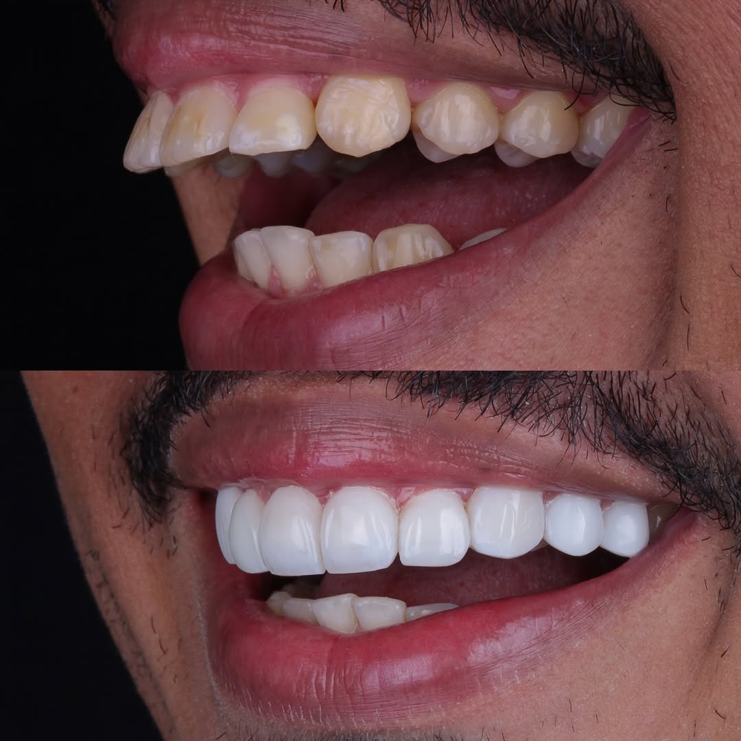 Ortodontia com alinhadores e aparelhos na DentClin