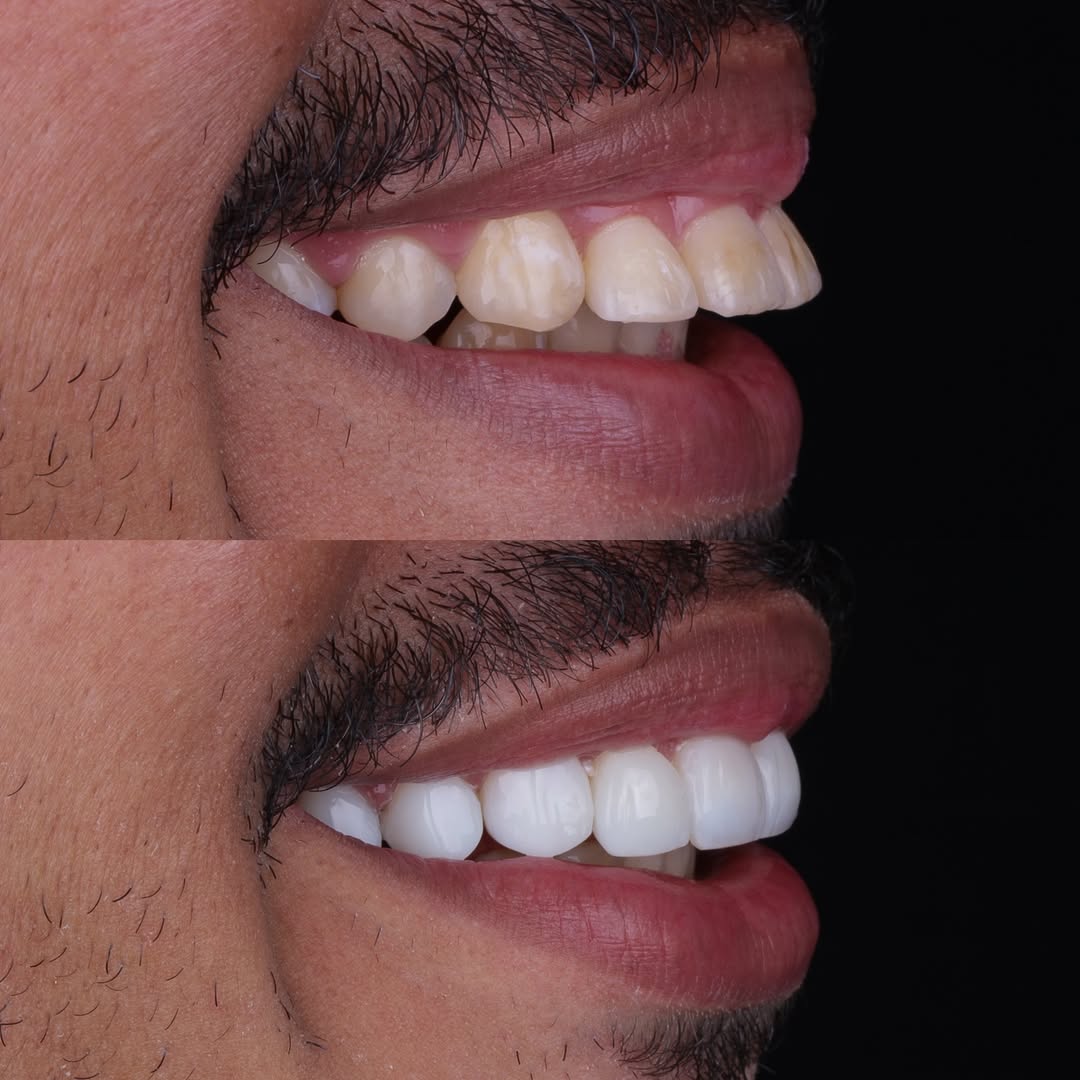 Ortodontia com alinhadores e aparelhos na DentClin