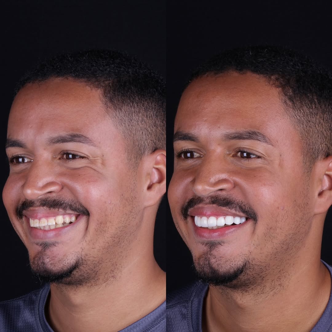 Ortodontia com alinhadores e aparelhos na DentClin