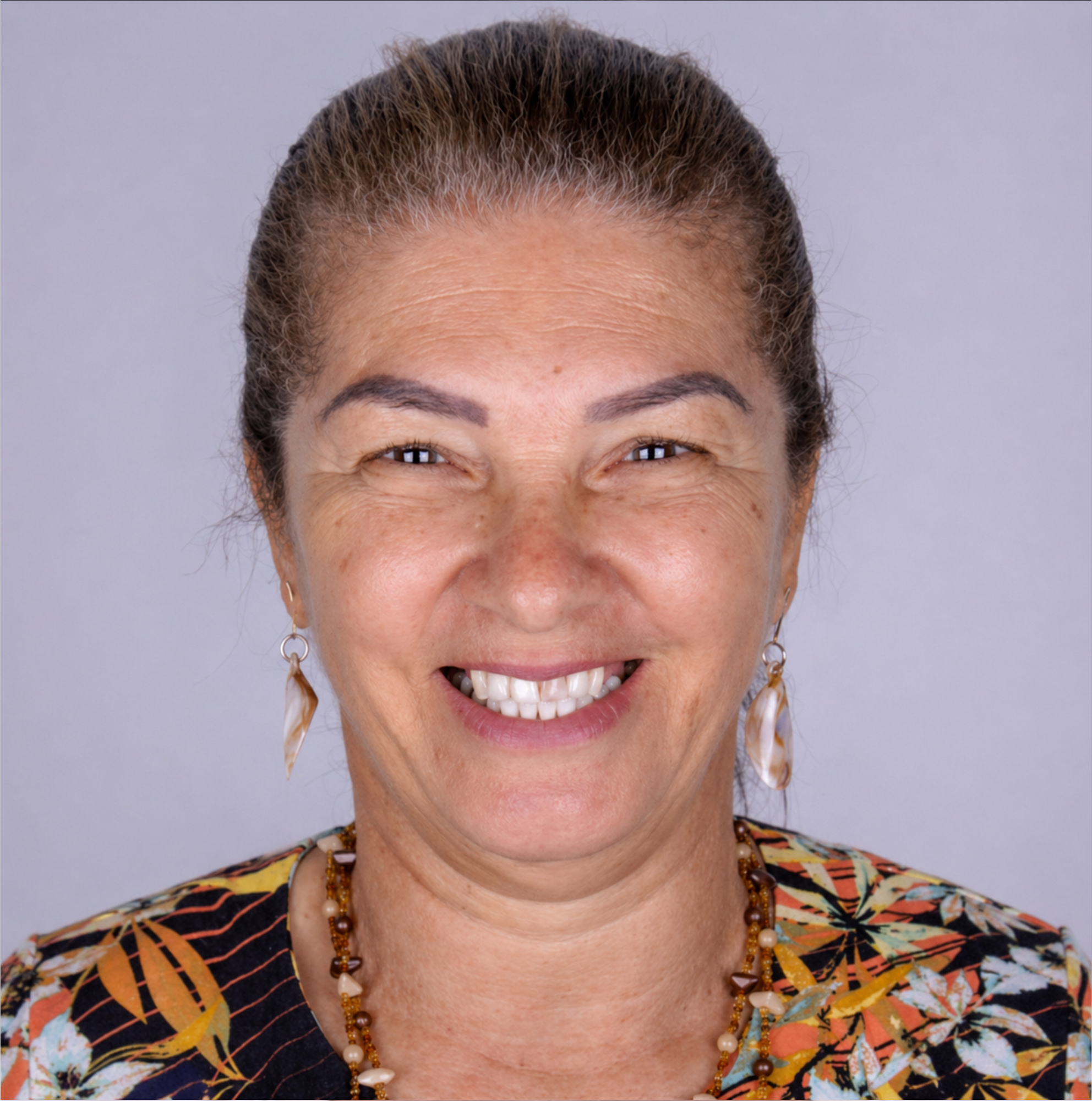 Caso Lentes em Porcelana antes