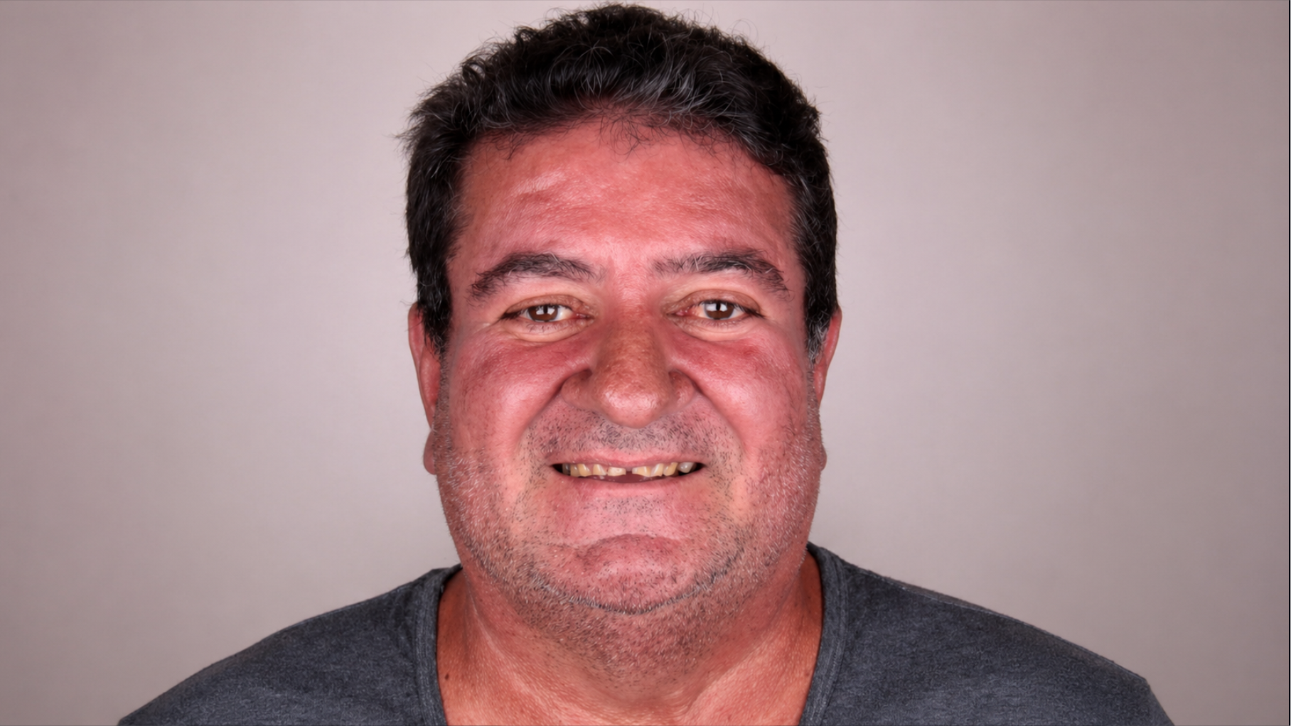 Caso Lentes em Porcelana antes