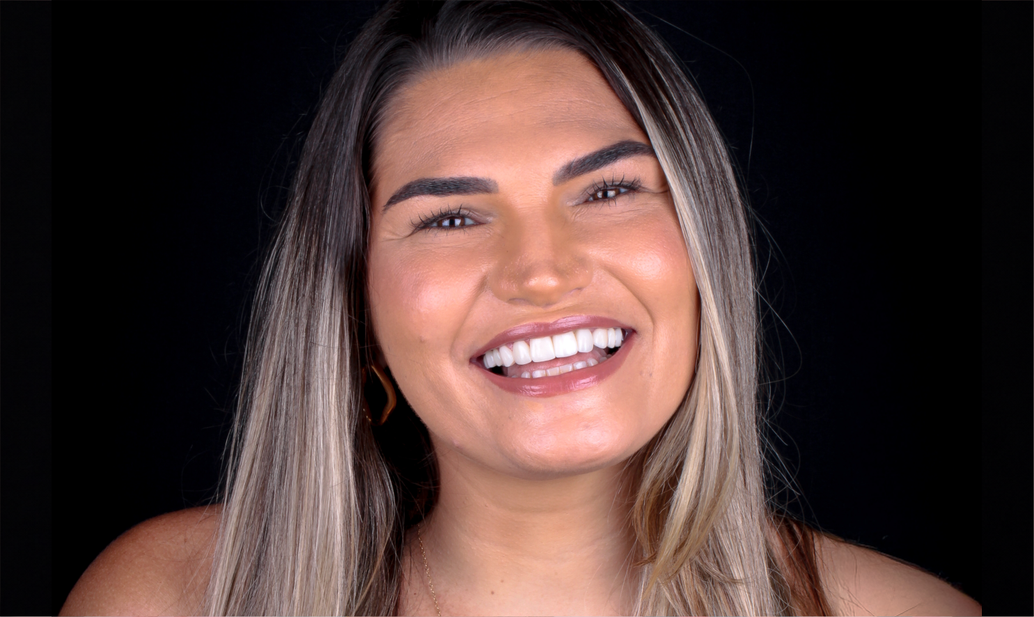 Facetas em resina e porcelana