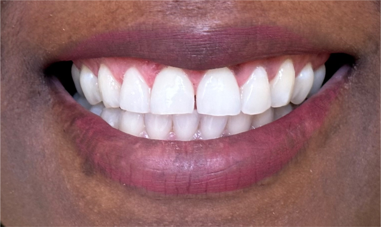 Plástica Periodontal